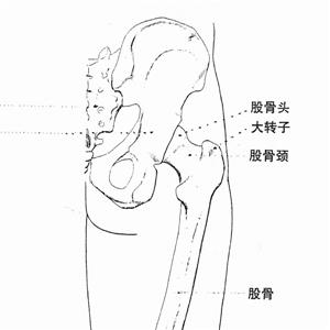 左股骨頸骨折內固定術被鑒定為九級工傷